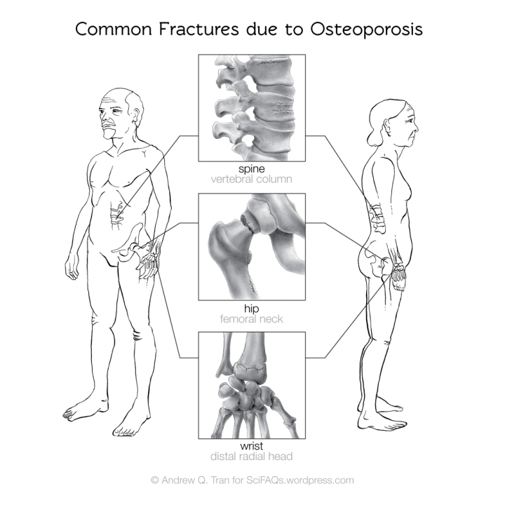 common-fractures-due-to-osteoporosis